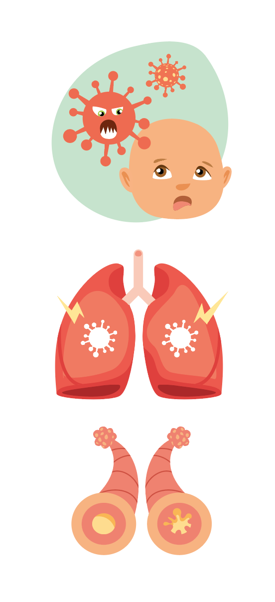 illustration bronchiolite