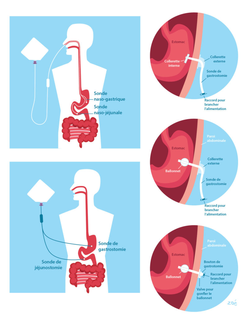 illustration schéma nutrition entérale